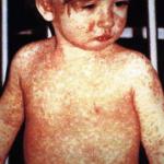 Third Measles Case of 2024 Confirmed in Georgia