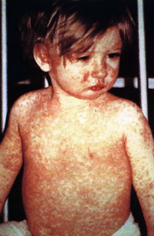 Third Measles Case of 2024 Confirmed in Georgia