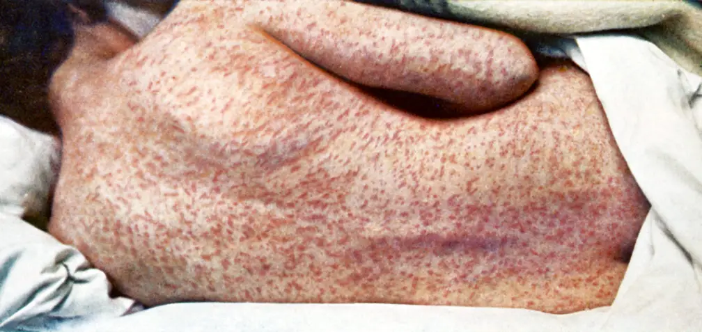 The Georgia Department of Public Health (DPH) confirmed two additional measles cases Friday in unvaccinated metro Atlanta residents. These two cases are family members of the case confirmed earlier this year in January.